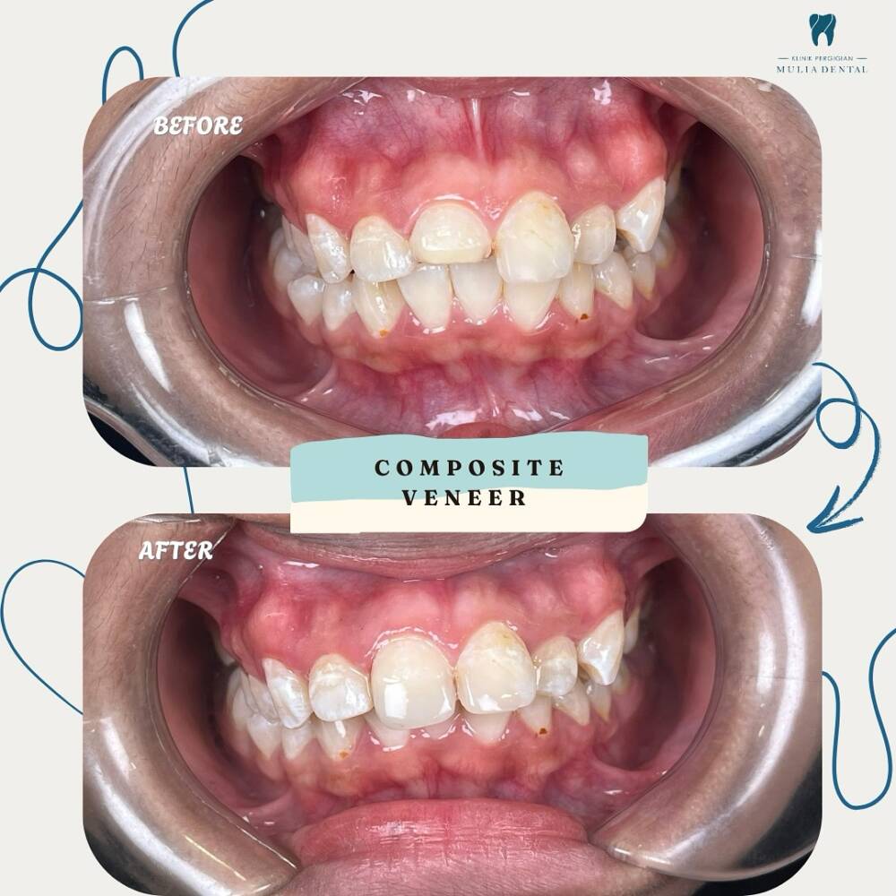 Malu nak senyum sebab gigi tak sama rata Composite veneer adalah pilihan tepat untuk perbaiki be