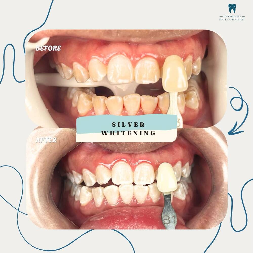 Result of Silver Whitening (3 cycle) 🤩🤩Do you know all our whitening packages include scaling