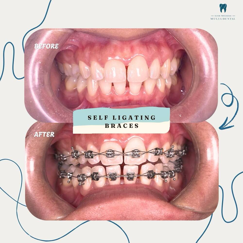 Self Ligating Braces Do you know we do have Braces promotion 😍Visit us at Klinik Pergigian Muli