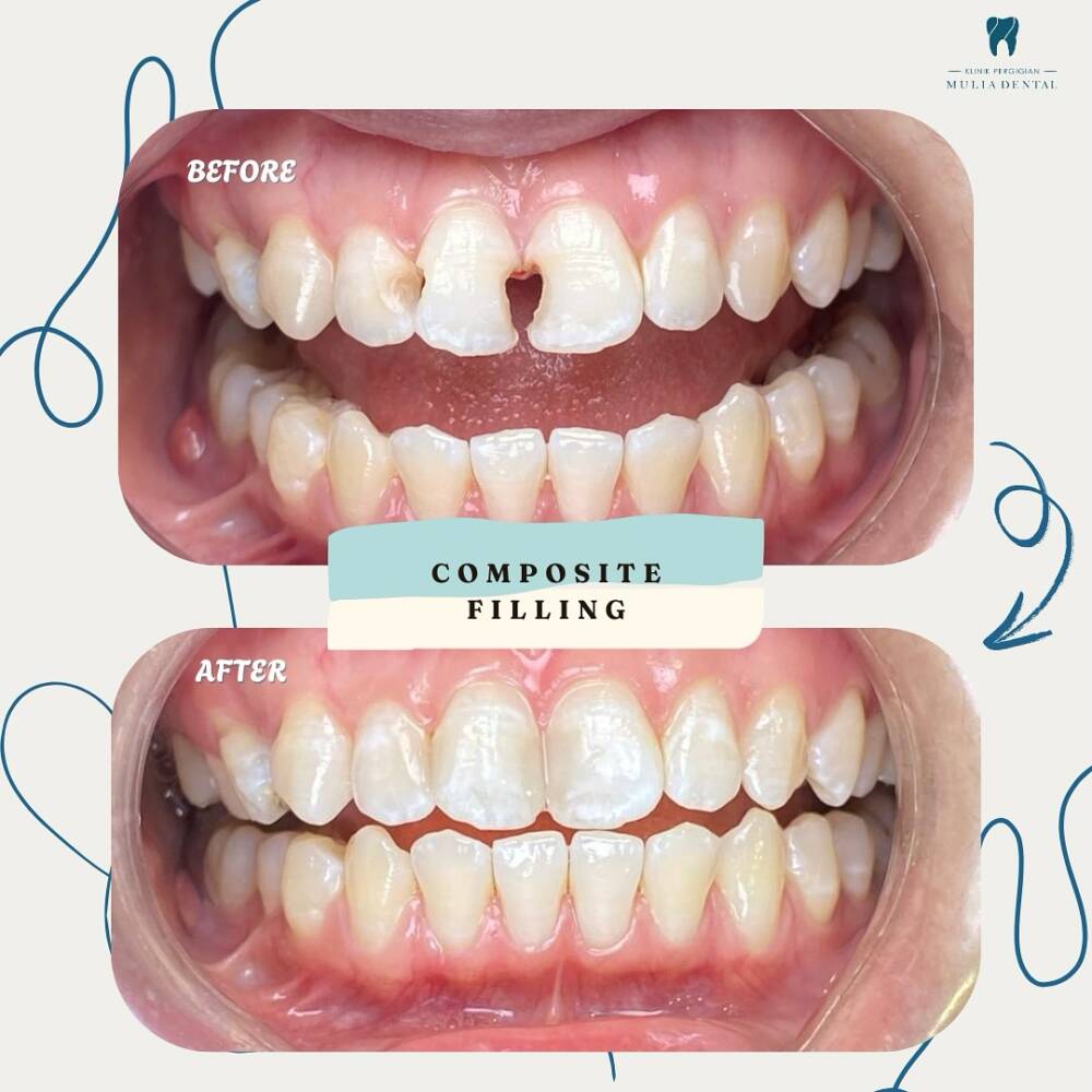 kenapa composite filling adalah pilihan terbaik 😉✅ Warna Seakan Asal (Natural Shade)Composite f
