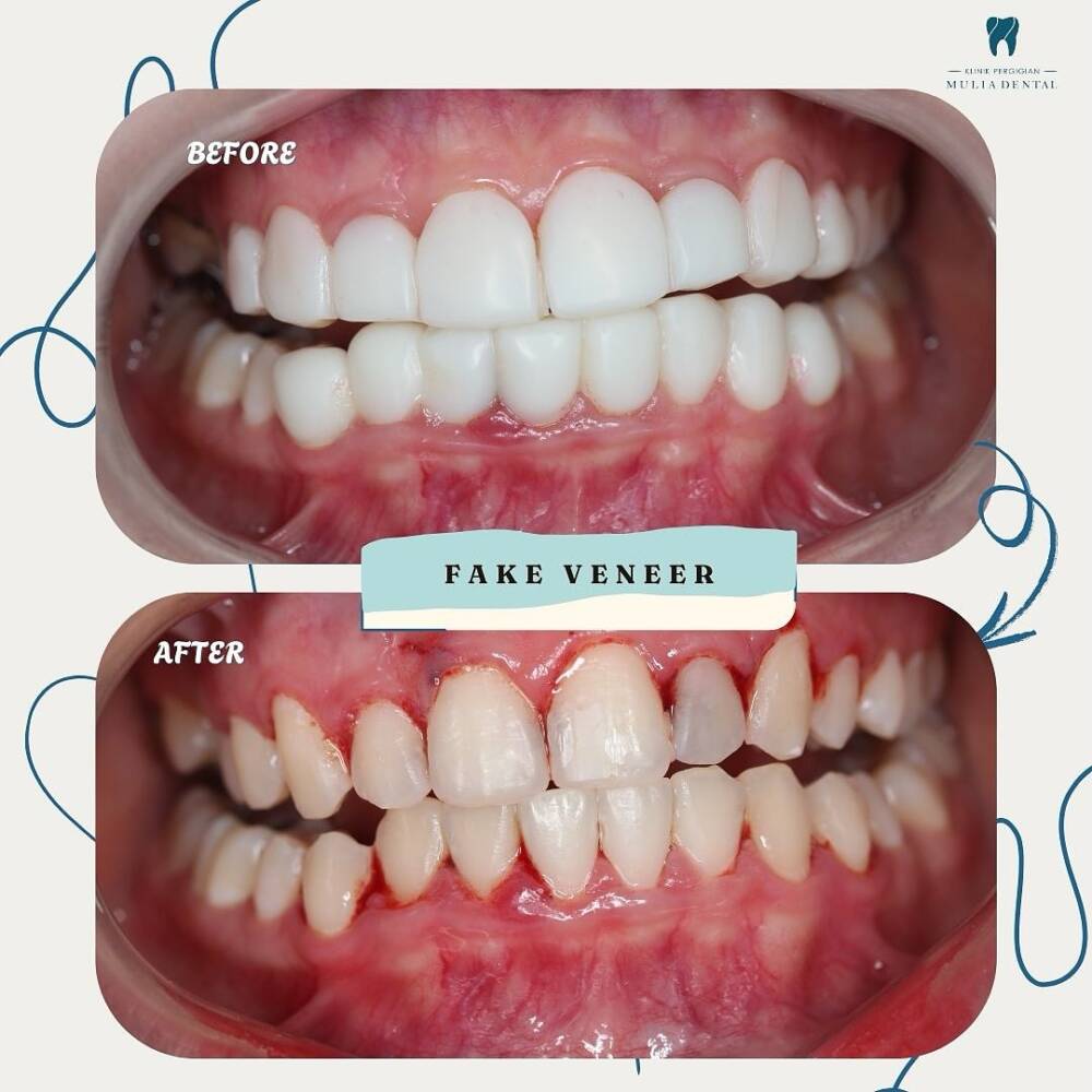 ⚠️ VENEER MURAH, GIGI MELARAT! ⚠️Pasang veneer bukan kat klinik Sekarang gigi sakit, gusi bengka